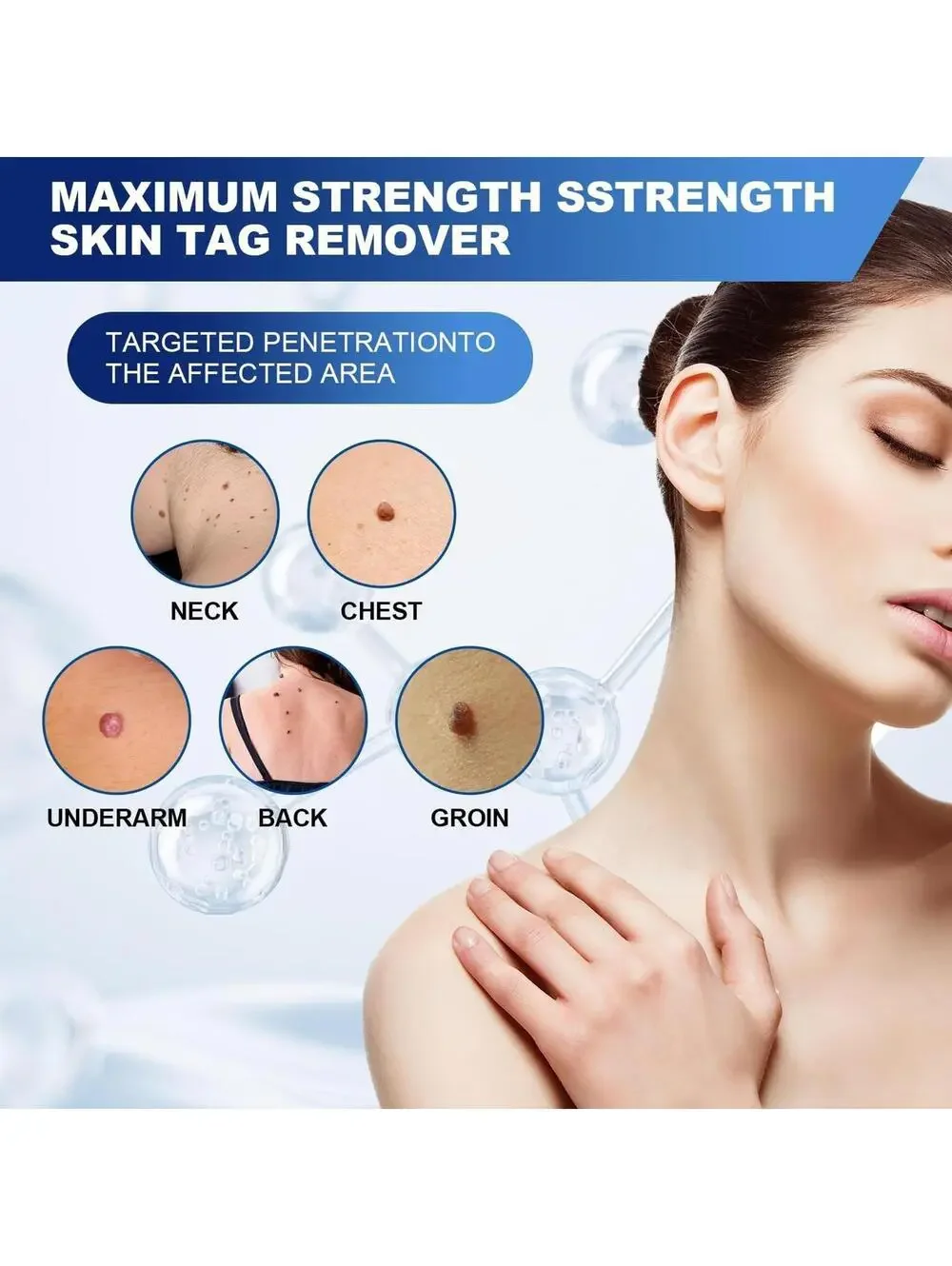 Fast-Acting Skin Tag Remover, Maximum Formula 30ml